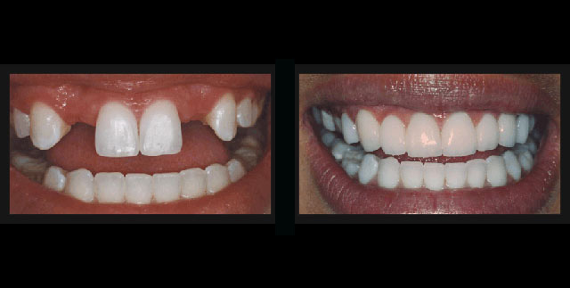 dental bridge before and after - Dallas Cosmetic and Restorative Dentist