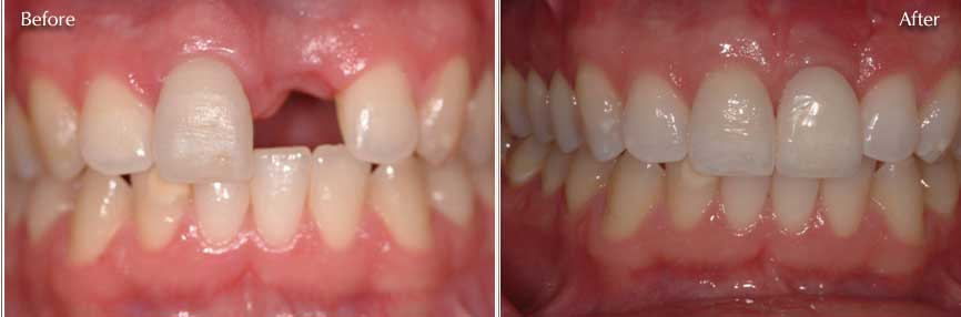 dental-implants-before-and-after